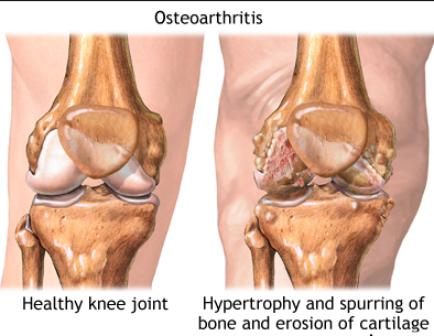 Osteoarthritis and how to take care of it