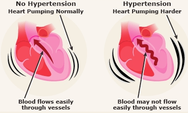 hypertension and how its handled