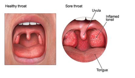 causes and treatment of sore throat